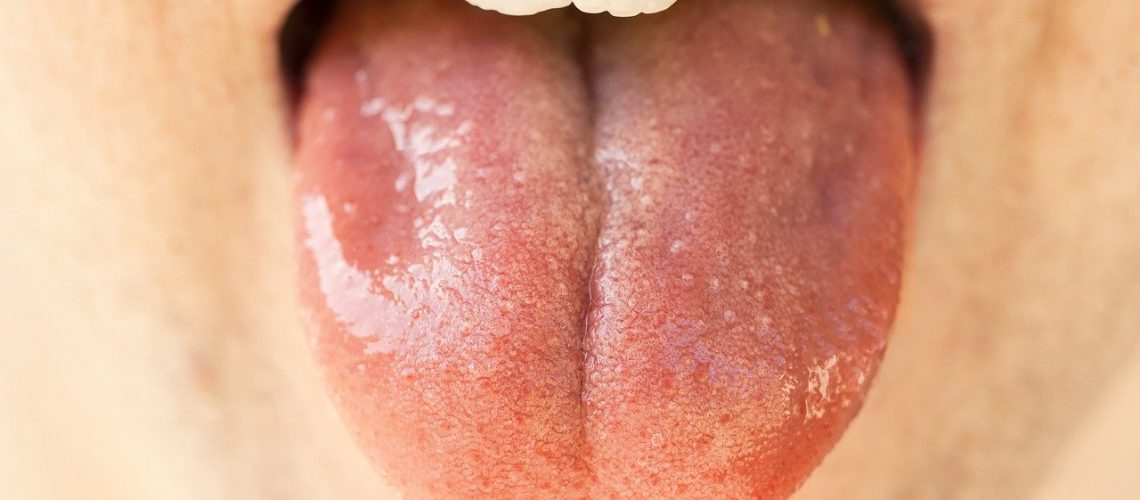 Dry Mouth with tongue wide open
