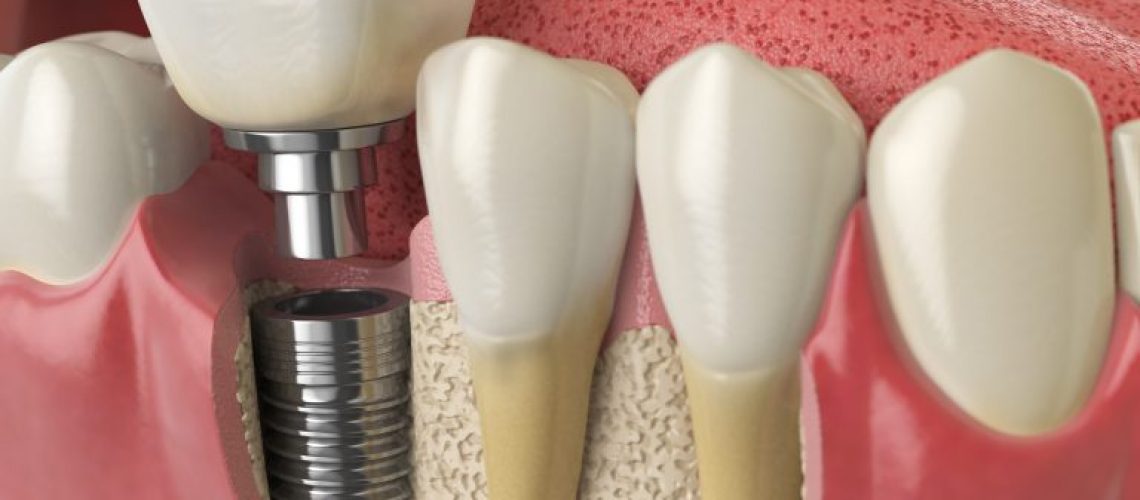 anatomy-of-healthy-teeth-and-tooth-dental-implant-P5PWYZQ-min-768x576